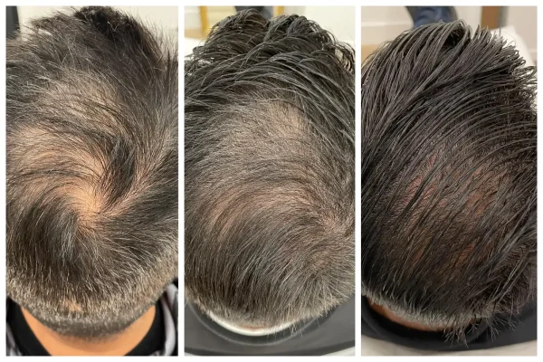 KeraLase Patient B&A