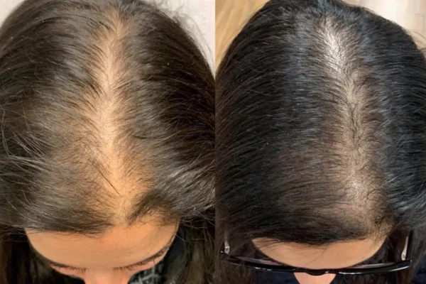 KeraLase Patient B&A