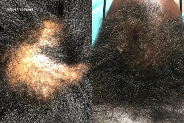 KeraLase Patient B&A