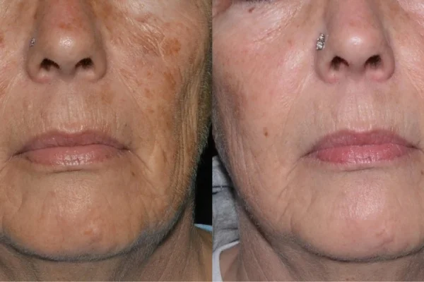 Laser Resurfacing Fraxel 1550 & LaseMD Ultra