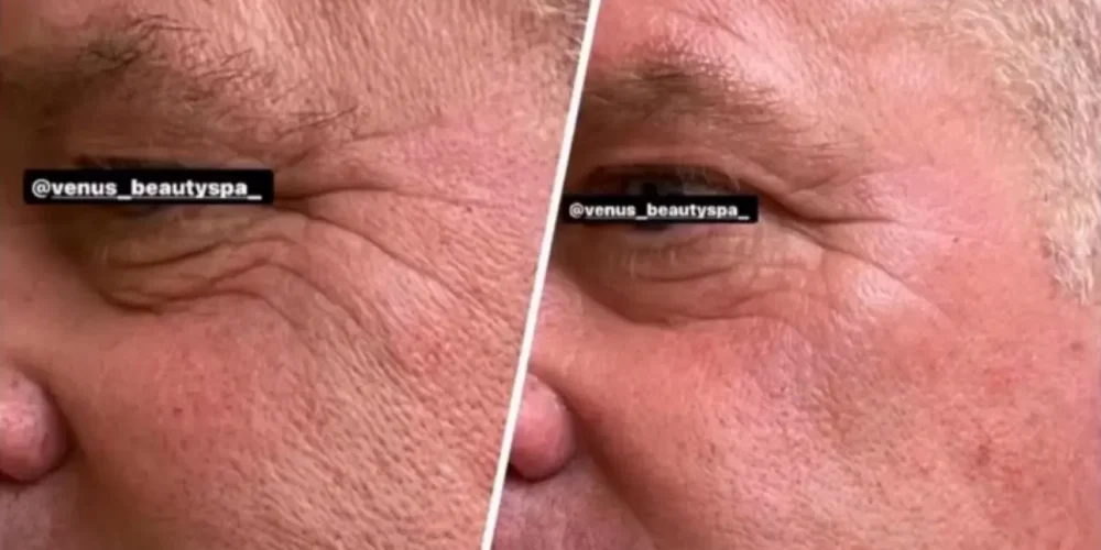 Microneedling RF Patient 1.1