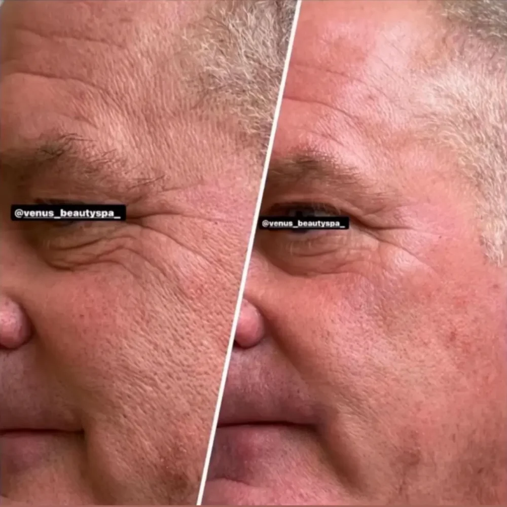 Microneedling RF Patient 1.1