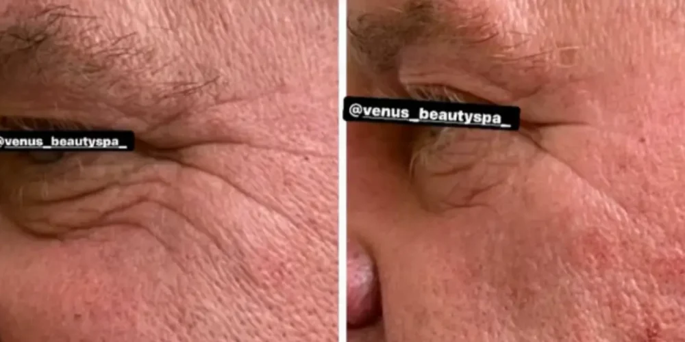 Microneedling RF Patient 1.2