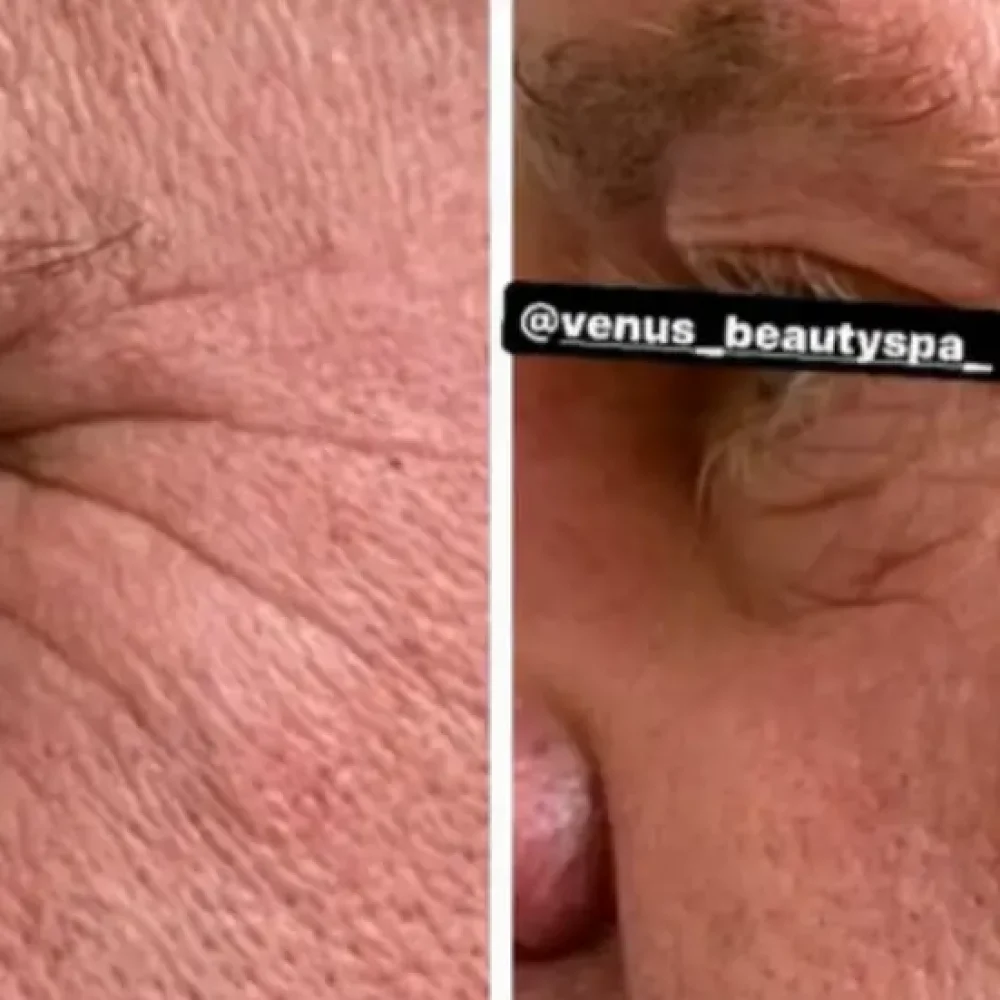 Microneedling RF Patient 1.2