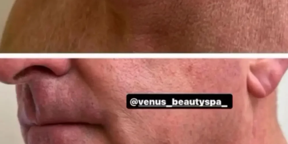 Microneedling RF Patient 1.3