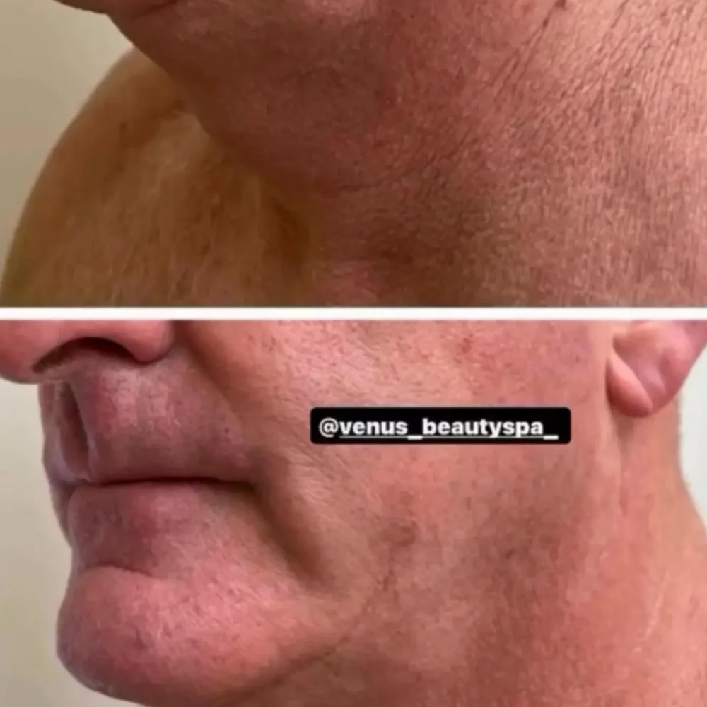 Microneedling RF Patient 1.3