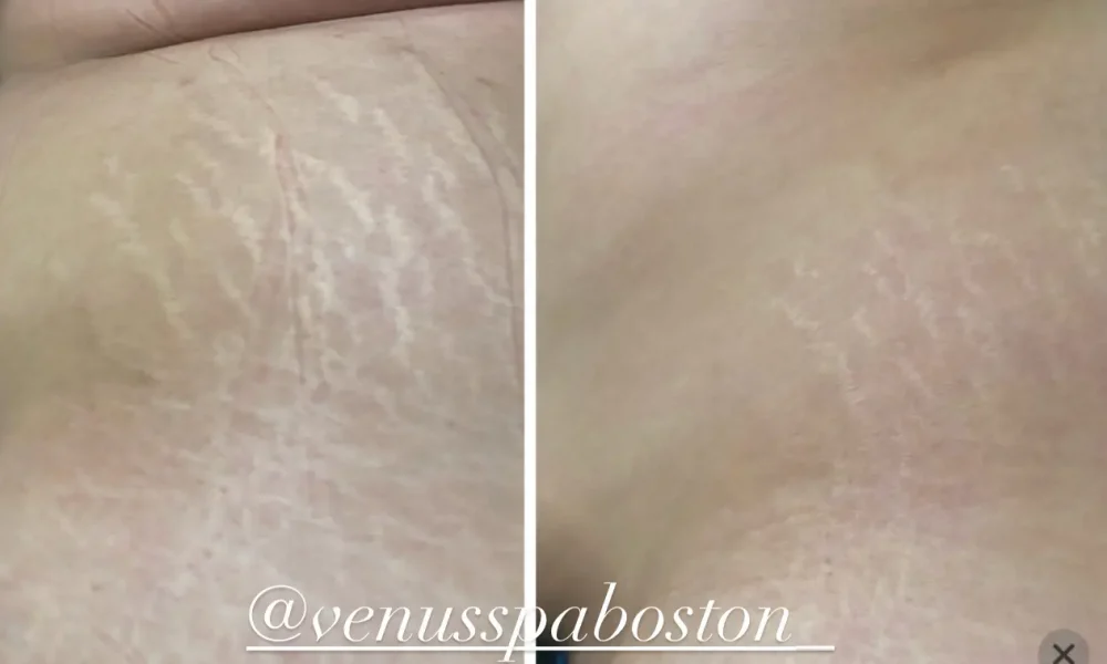 Stretch Marks Patient 1