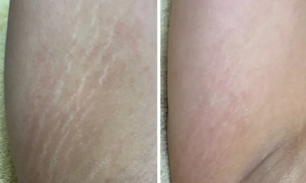 Stretch Marks Patient 3