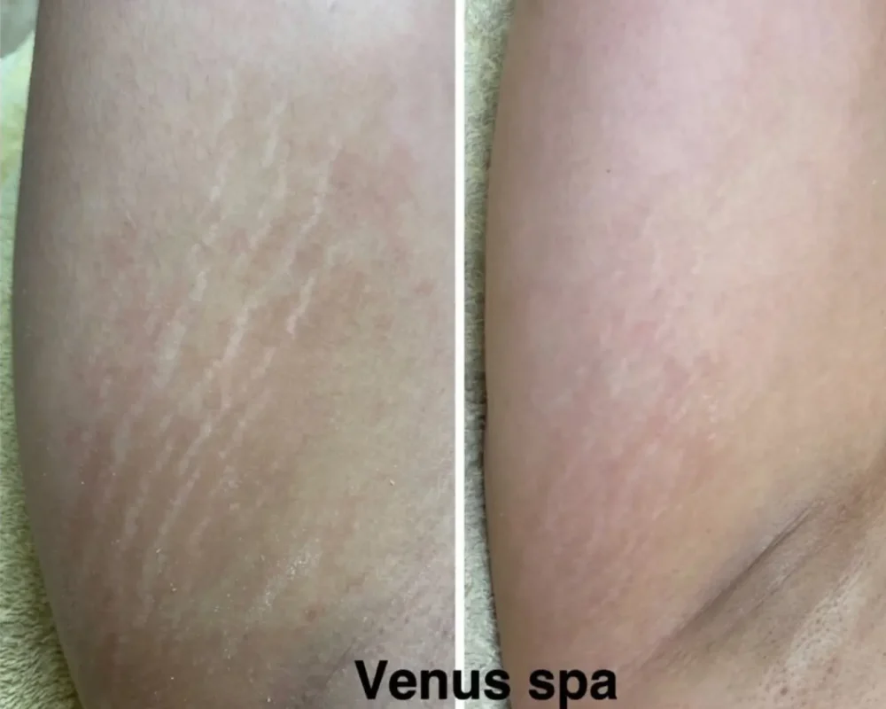 Stretch Marks Patient 3