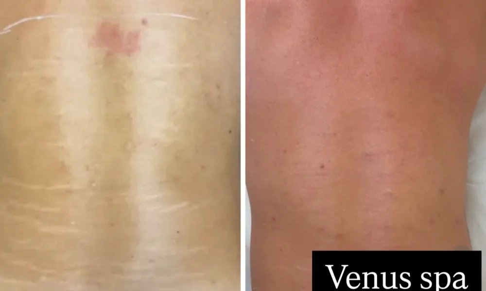 Stretch Marks Patient 2