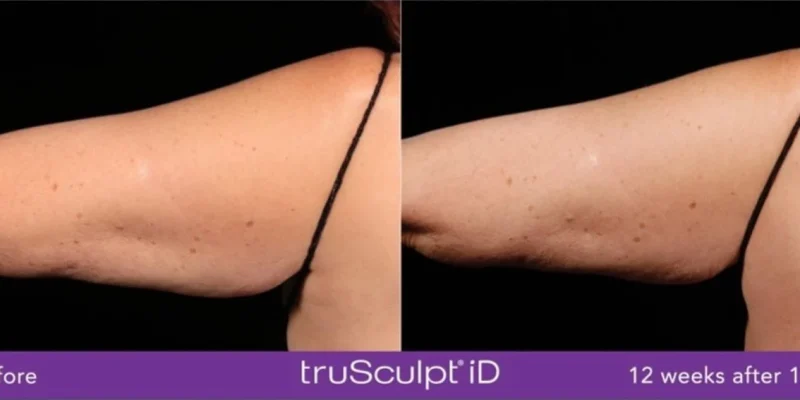 truSculptID