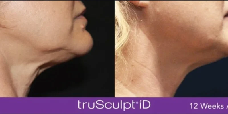truSculptID